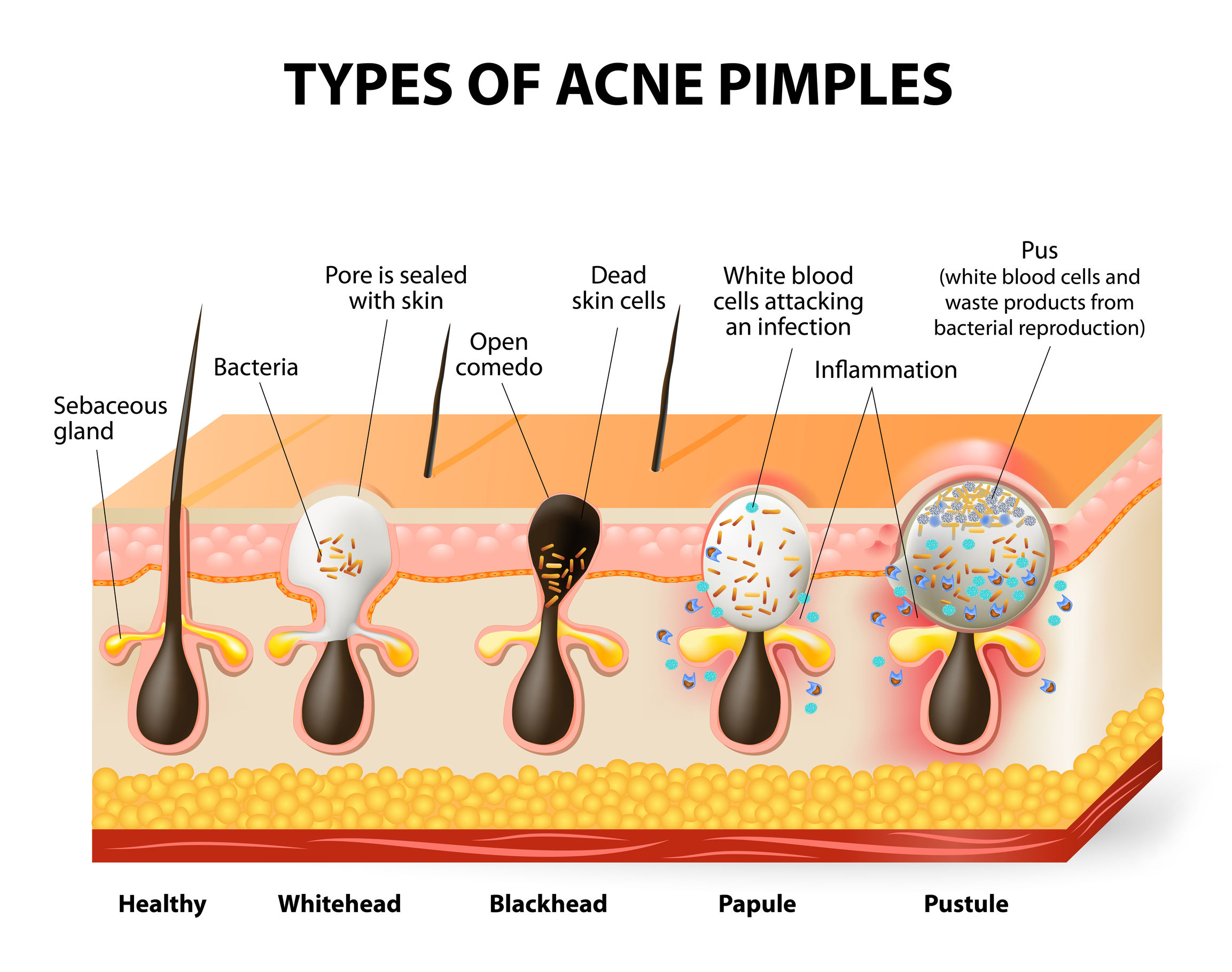 types-of-acne-diagram - Gunilla of Sweden®