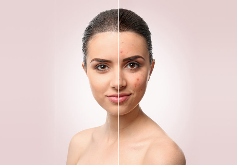 Acne Clearing Times Using LEROSETT® Scroll Down for Acne Clearing Charts