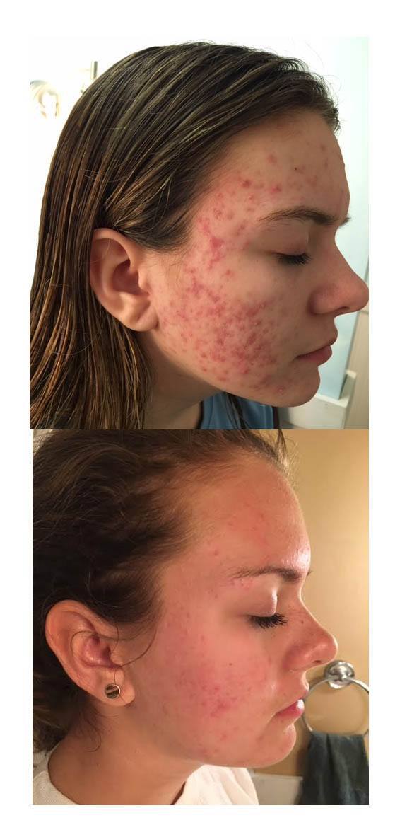 General Acne FAQ