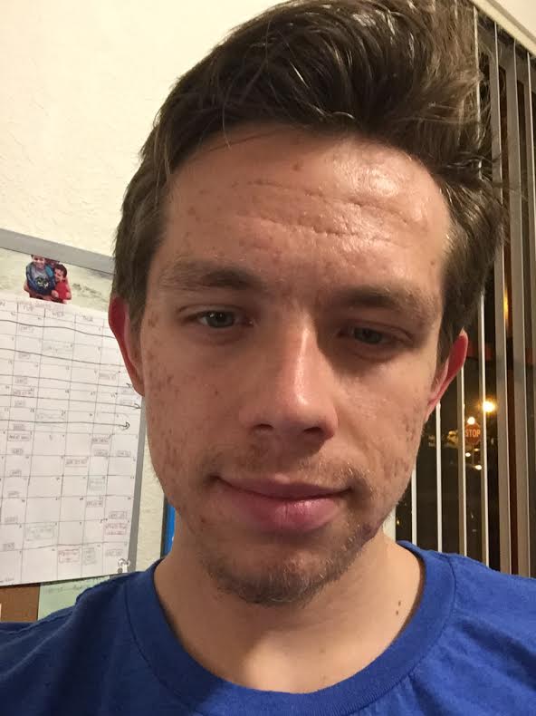 LEROSETT® User Results for Clearing Cystic Acne David M.