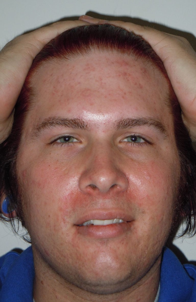 LEROSETT® Cystic Acne Interview with Seth N.