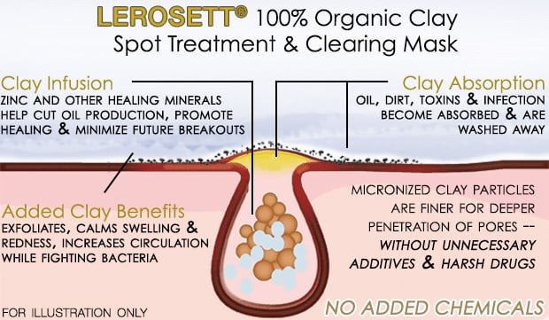 Lerosett Clay Treatment