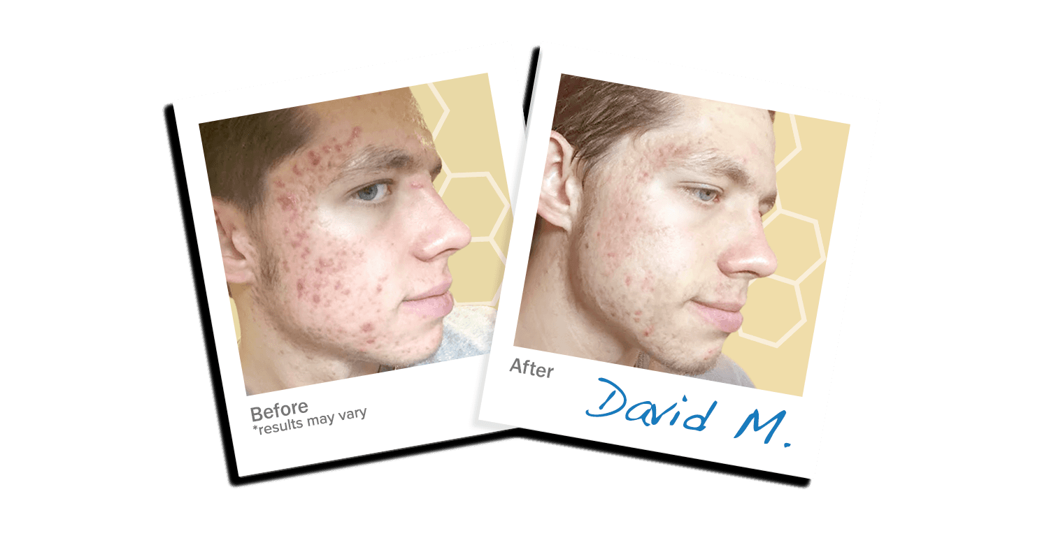LEROSETT® Botanical Acne Kit