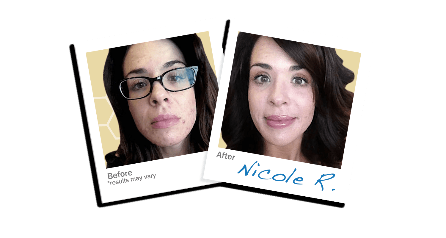LEROSETT® before after acne photos