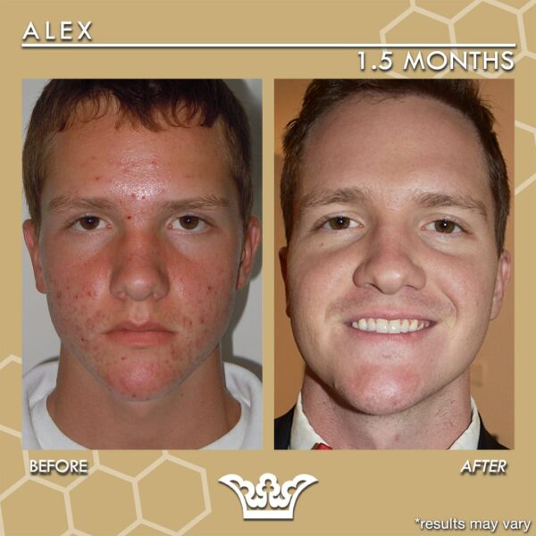 before after  AlexBAinsta before and after