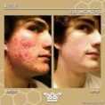 before and after