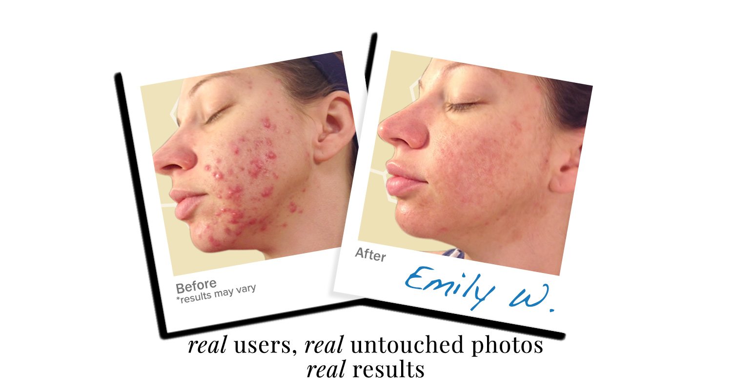 LEROSETT® Spot Treatment Clearing Mask