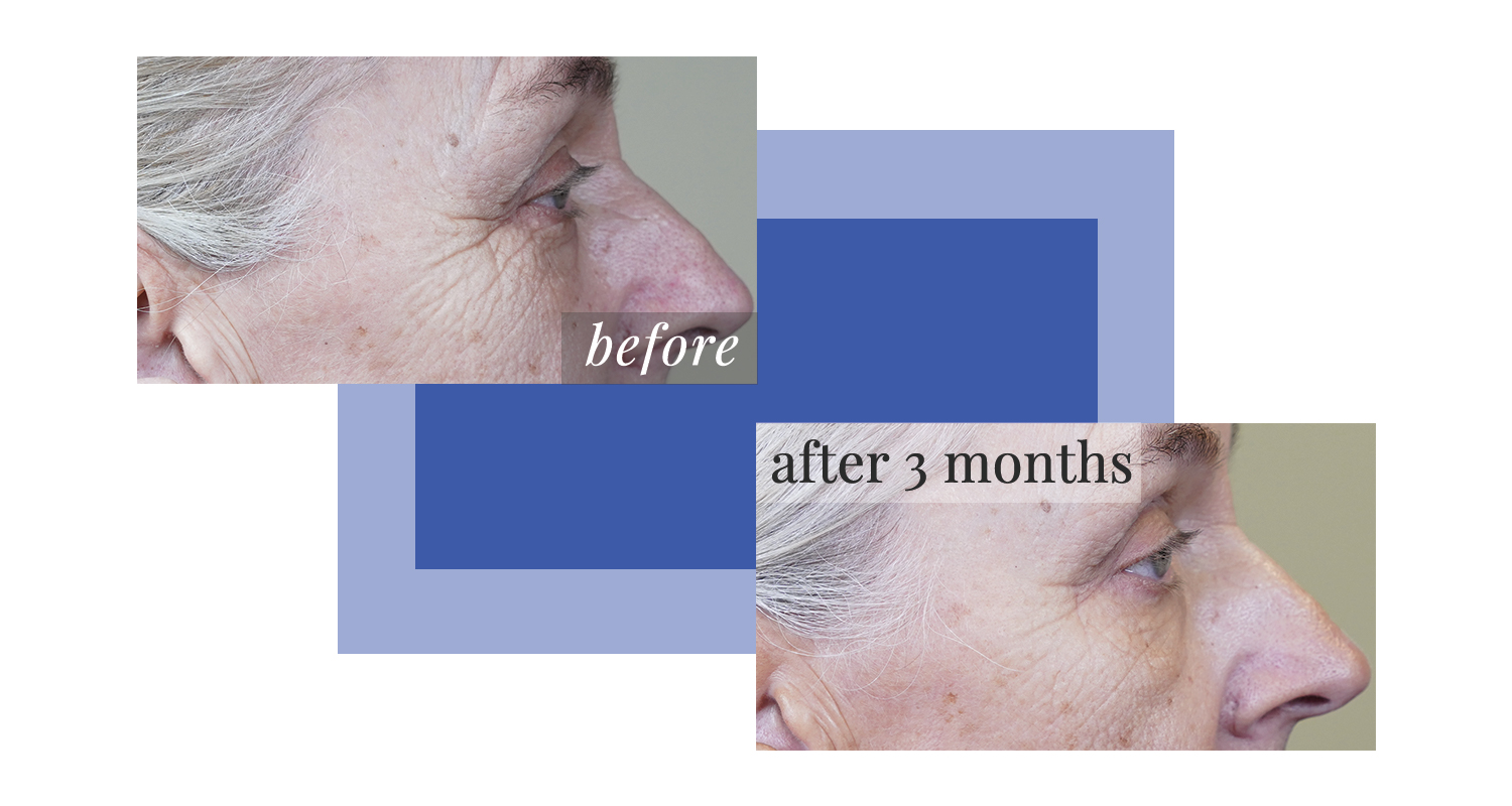 Bonnie W, Before After GUNILLA Organic Skin Care Kit