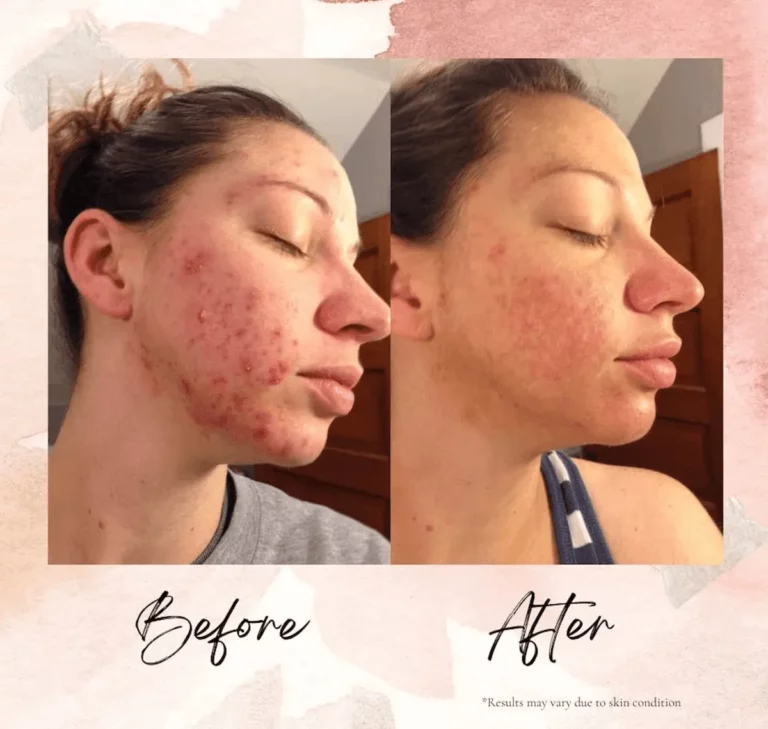 FAQ LEROSETT® Organic Acne Products