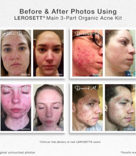 before & After