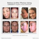BEFORE AFTER 4 UP Organic-Acne-Collection