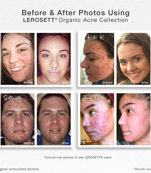 BEFORE AFTER 4 UP Organic-Acne-Collection