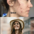 Lerosett healing serum before & after
