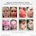 Organic-Acne-Kit Before & After