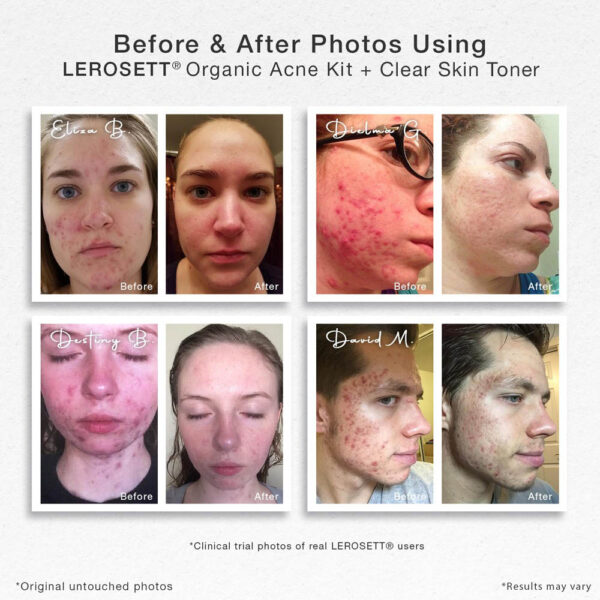 Organic-Acne-Kit Before & After