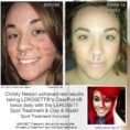 Chris before and after acne supplements, Clearpoint