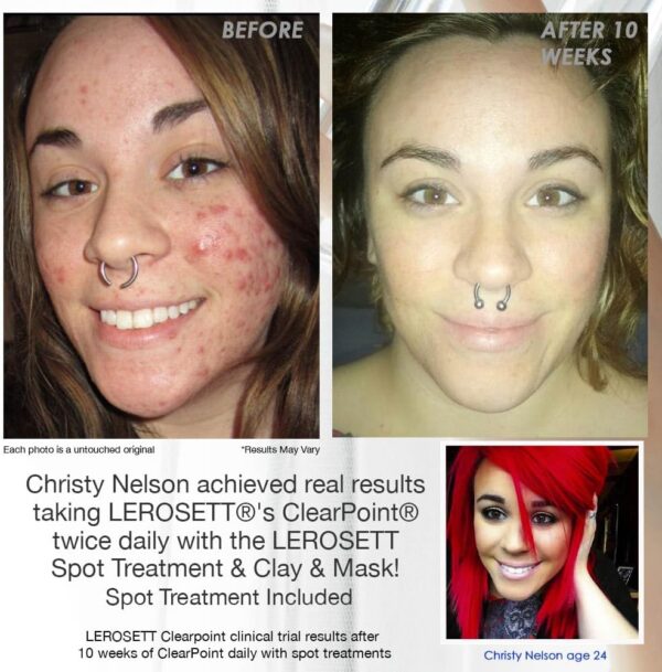 LEROSETT-SUPPLEMENTS-BEFORE-AFTER-CHRIS2.1 Chris before and after acne supplements, Clearpoint